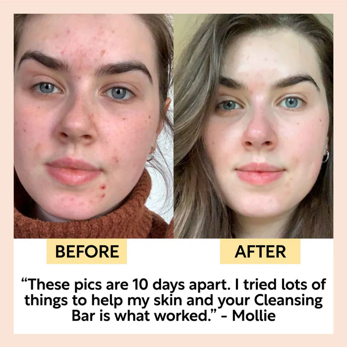 UpCircle Acne-Prone Skincare Formula Bundle