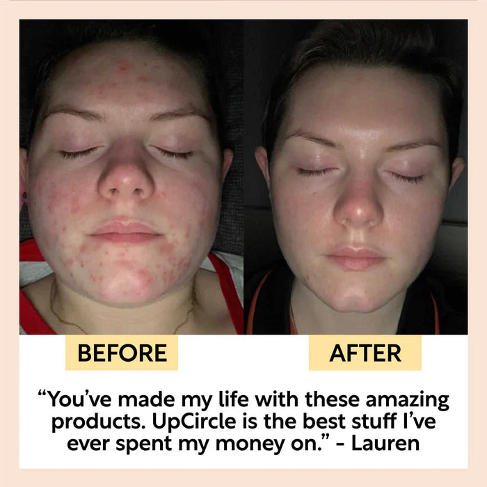 UpCircle Acne-Prone Skincare Formula Bundle